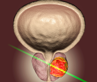 Seis señales tempranas de cáncer de próstata